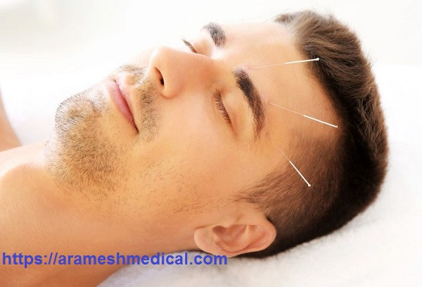 درمان میگرن با طب سوزنی