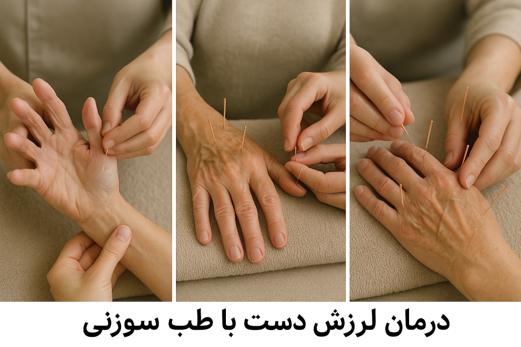 درمان لرزش دست با طب سوزنی