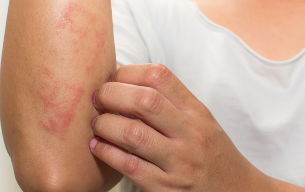 زونا-بیماری