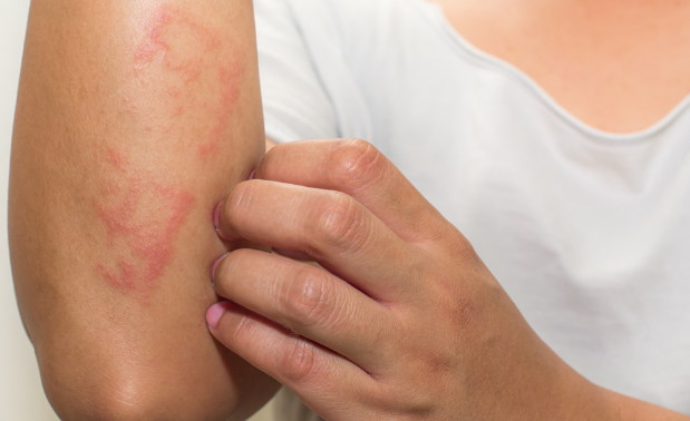 زونا-بیماری